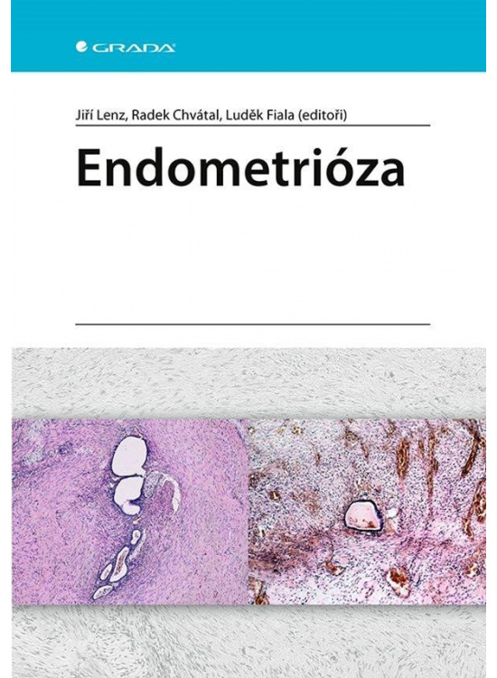 Levně Endometrióza