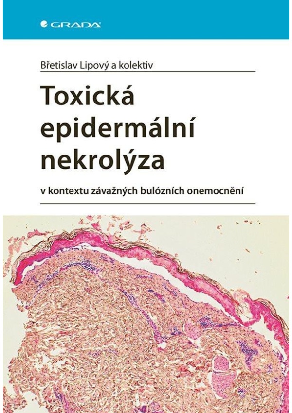 Levně Toxická epidermální nekrolýza v kontextu závažných bulózních onemocnění