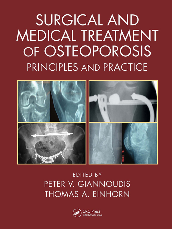 Levně Surgical and Medical Treatment of Osteoporosis